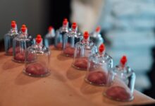 Cupping is trending but does it help recovery