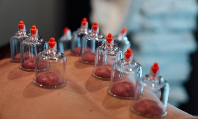 Cupping is trending but does it help recovery