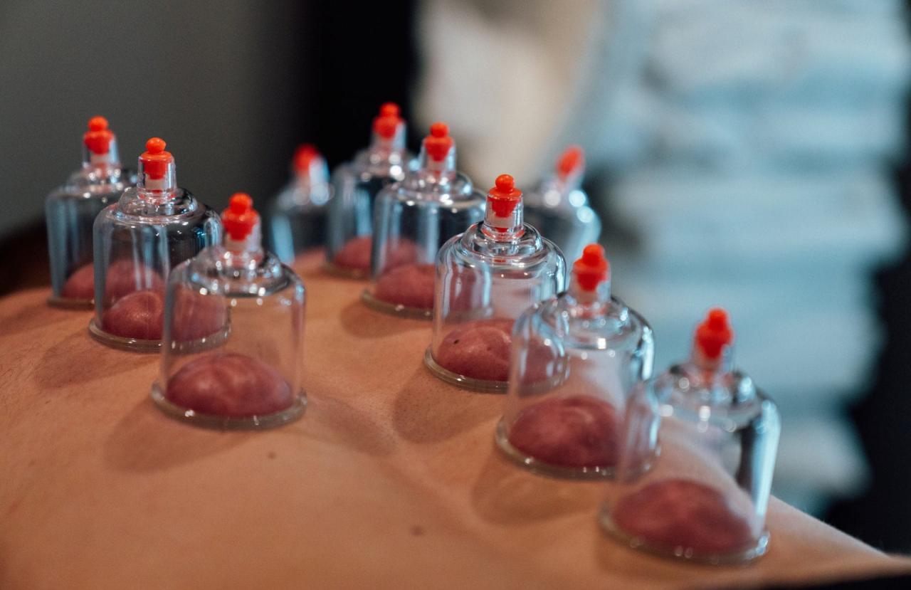 Cupping is trending but does it help recovery