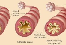 Science says changing your diet could help manage asthma