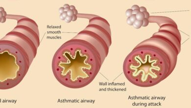 Science says changing your diet could help manage asthma