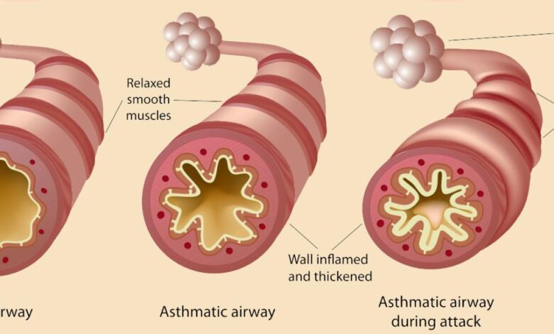 Science says changing your diet could help manage asthma