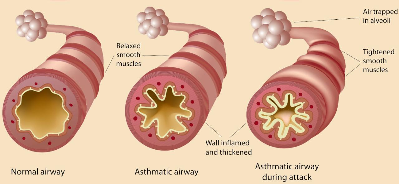 Science says changing your diet could help manage asthma