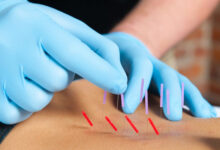 What is dry needling and should you try it