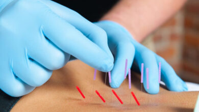 What is dry needling and should you try it