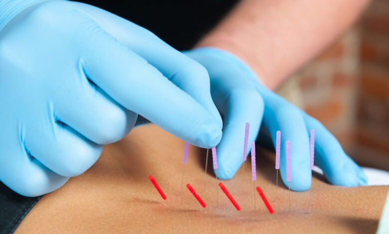 What is dry needling and should you try it