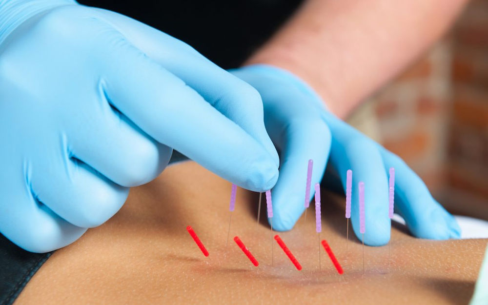 What is dry needling and should you try it