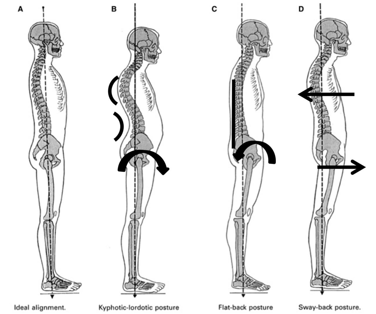 Posture spine alignment ideal types different skeletal system pilates affect effect soft pain joints musculoskeletal