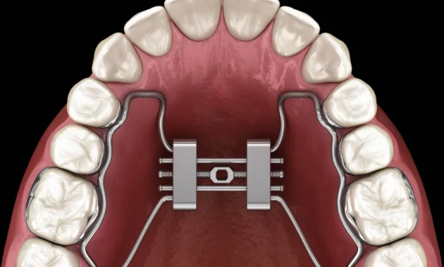 Understanding Palatal Expanders: A Comprehensive Guide to Correcting ...